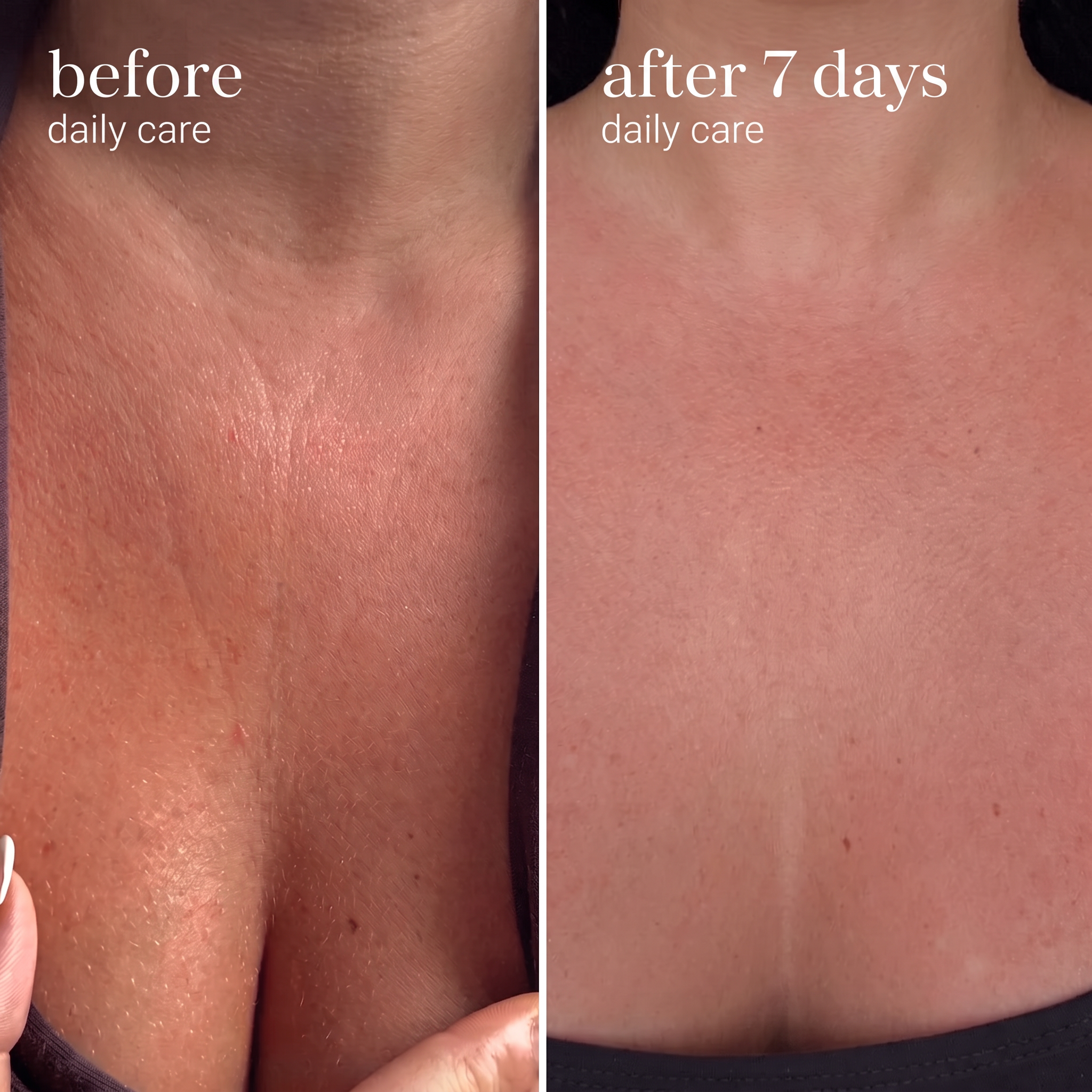 Décolletage skin before and after seven days of daily Axonix serum