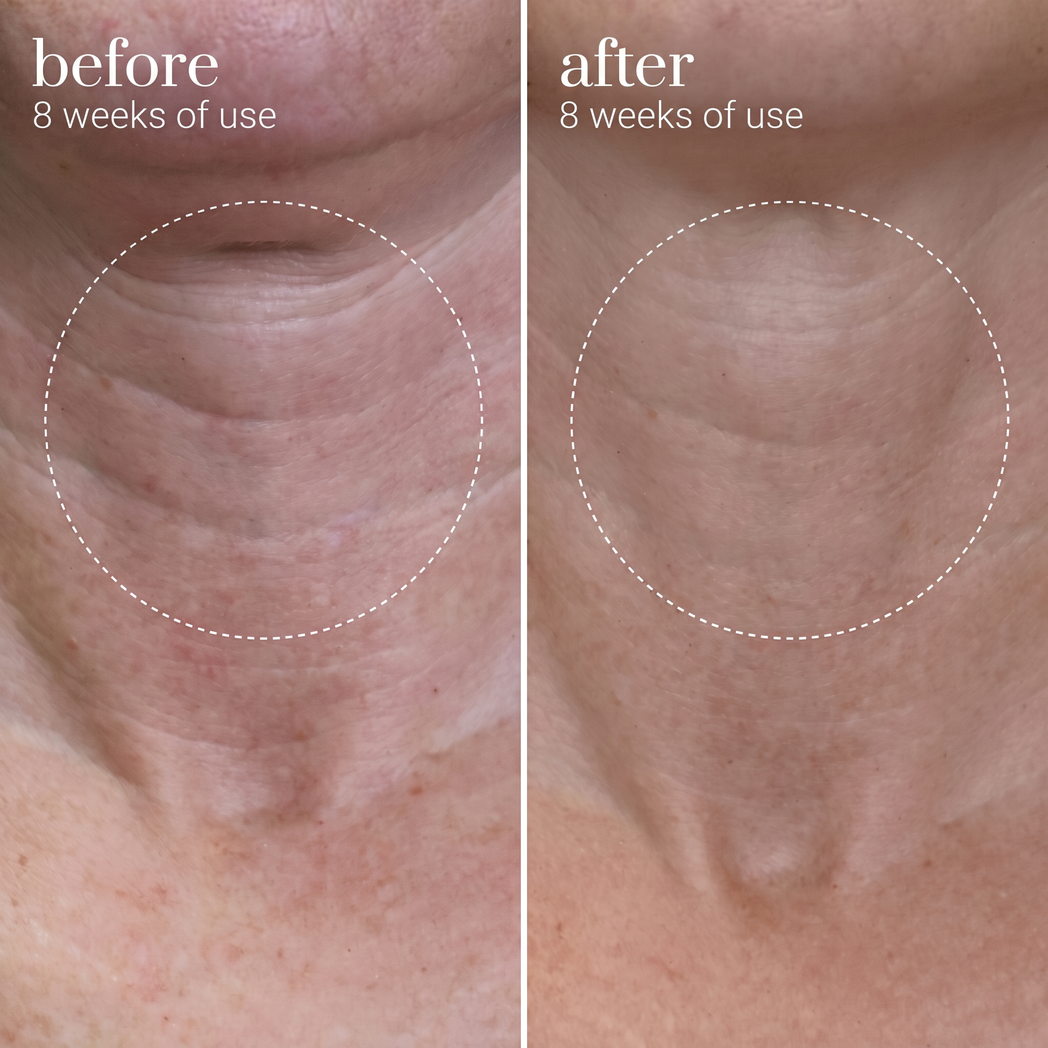 Neck skin before and after eight weeks of using Axonix serum